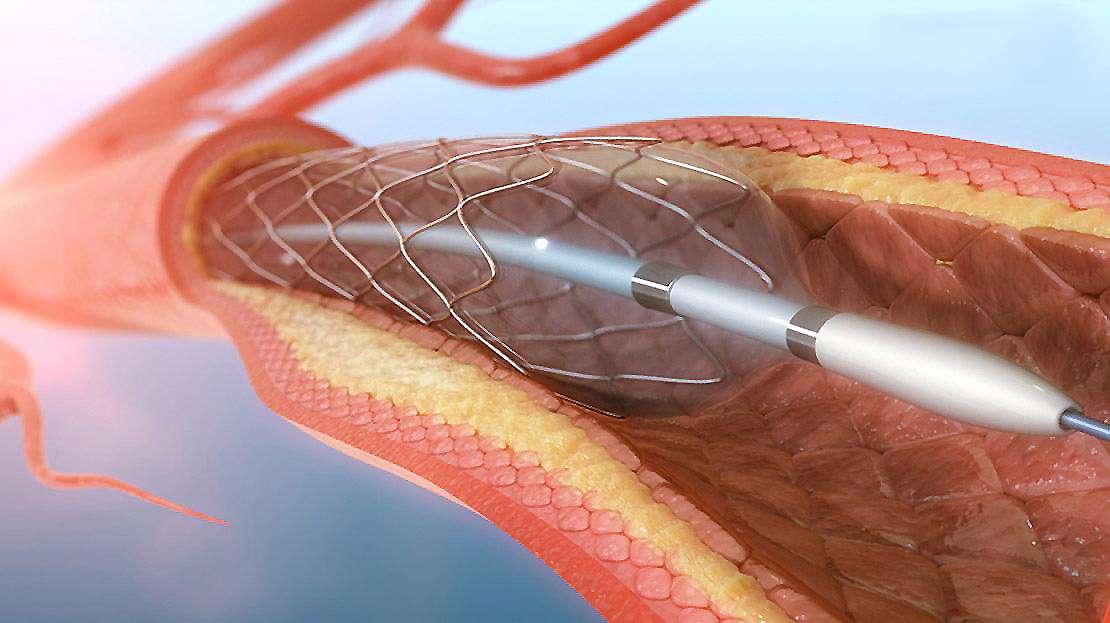 Percutaneous Transluminal Coronary Angioplasty (PTCA) - Stent - AKUT KALP  DAMAR HASTANESİ